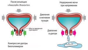 Беременность недержание мочи при кашле