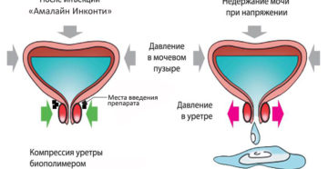 Беременность недержание мочи при кашле