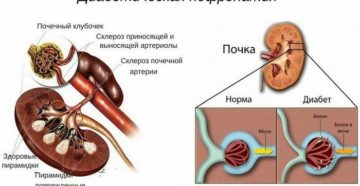Заболевание почек при диабете