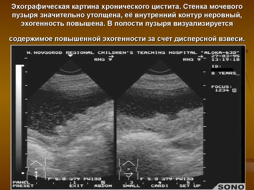 Утолщение задней стенки мочевого пузыря у женщин