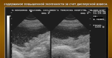Утолщение задней стенки мочевого пузыря у женщин