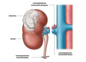 Удаление почки с опухолью последствия