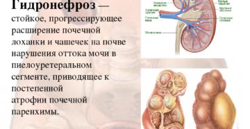 Почему расширены почечные лоханки