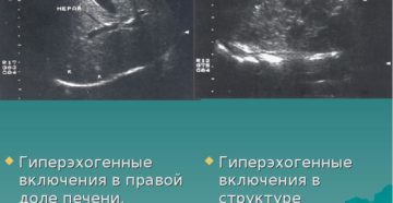Гиперэхогенные сигналы в почках что это такое