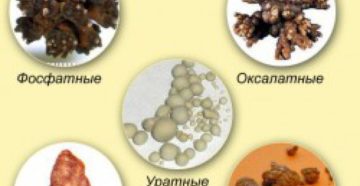 Какая трава растворяет оксалатные камни в почках