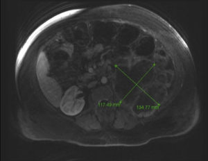 Светлоклеточный рак почки g3 прогнозы после удаления