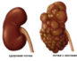 К какому врачу обратиться с кистой почки