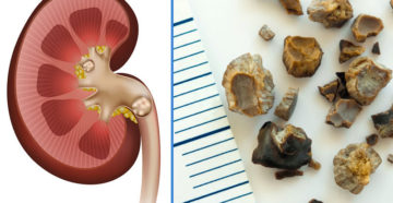Камни в почках у ребенка 12 лет