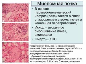 Миеломная болезнь почек