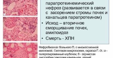 Миеломная болезнь почек