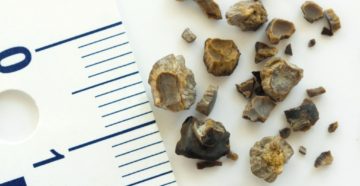 Где можно исследовать камни из почек