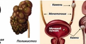 Если откажут почки