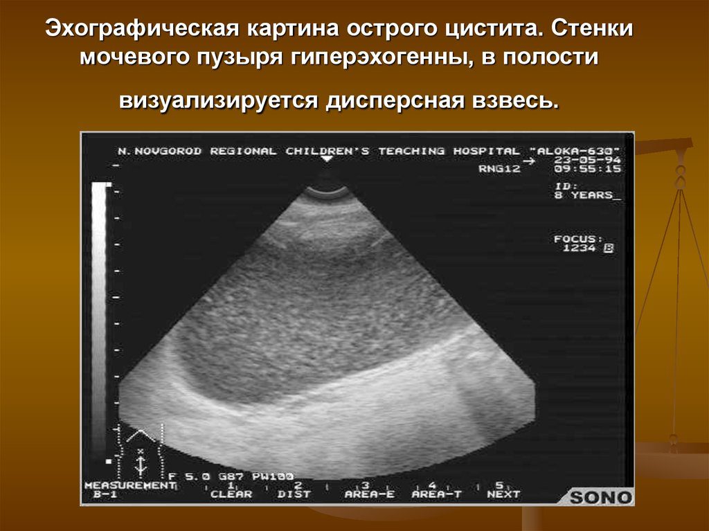 На узи осадок в мочевом пузыре у ребенка