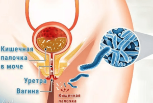 Кишечная палочка в уретре у мужчин симптомы