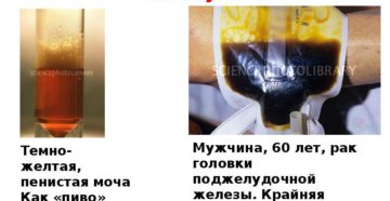 Моча цвета пива отмечается при