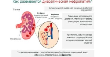 Нефропатия 1 степени правой почки