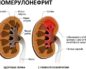 Патология клубочкового аппарата почек