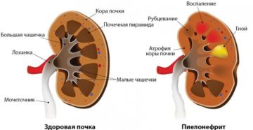 Воспаление лоханки почки у детей
