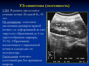 Изоэхогенное образование в почке