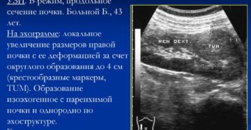 Изоэхогенное образование в почке