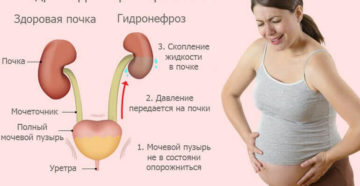 Что делать когда болят почки у беременных