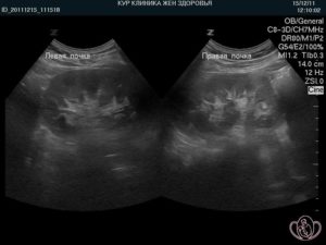 Видно ли беременность на узи почек