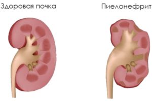 Пиелонефрит симптомы у женщин после родов