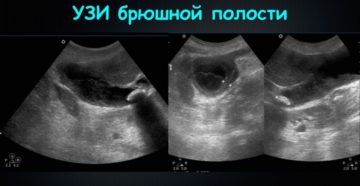 Узи брюшной полости входит ли почки