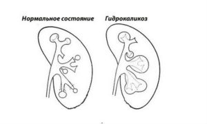 Каликоэктазия почек причины