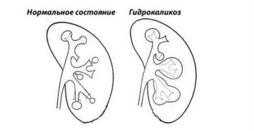 Каликоэктазия почек причины