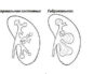 Каликоэктазия почек причины