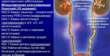 Мкб 10 соли в почках