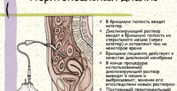 Что такое перитонеальный диализ