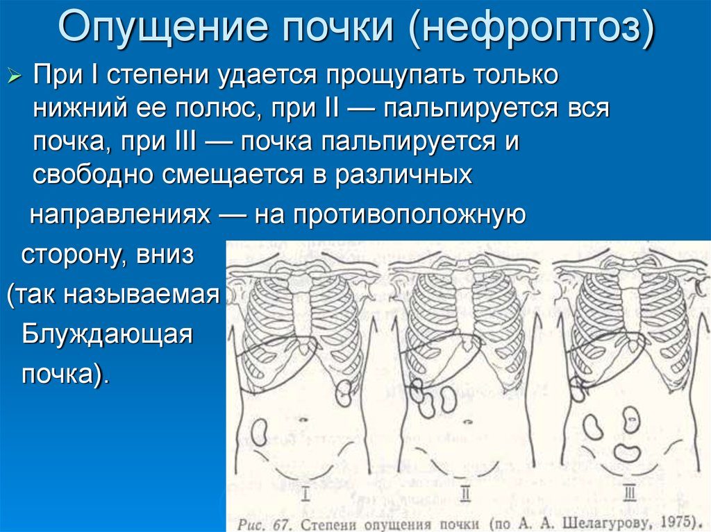 Что делать при нефроптозе почки