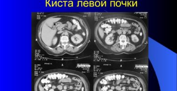 Кистозная структура левой почки