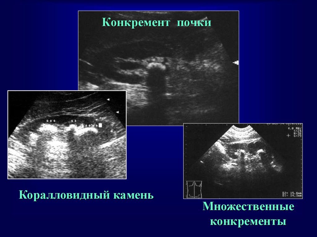 Признаки конкрементов почек что это такое