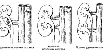 Полное удвоение члс почек что это такое