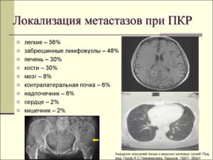 Рак почки с метастазами в печень лечение