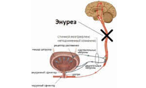 Причины недержание мочи ночью у мужчин причины