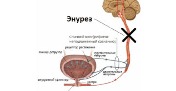 Причины недержание мочи ночью у мужчин причины
