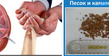 Какие признаки при выходе песка из почек