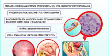 Уреаплазменный уретрит у мужчин симптомы и лечение