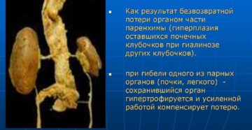 Викарная гиперплазия единственной левой почки