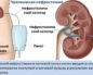 Катетер в почке при камнях