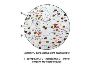 Откуда лейкоциты в моче