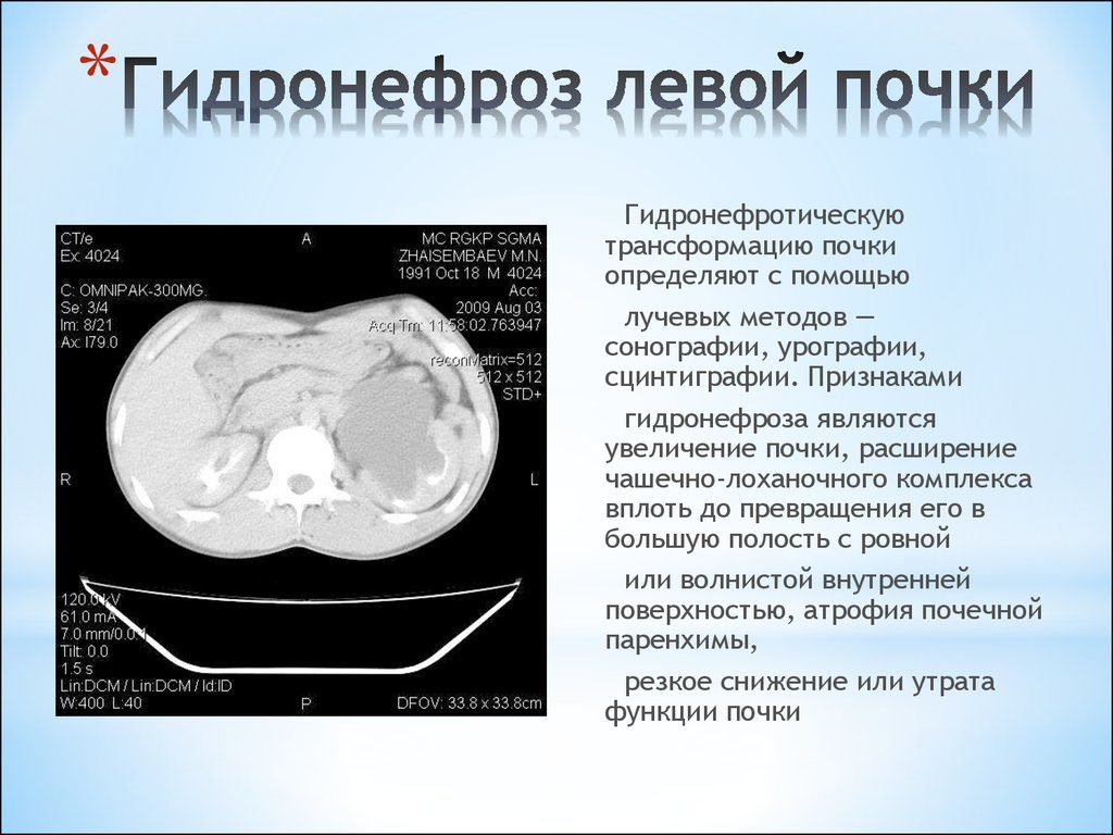 Гидронефроз 2 степени левой почки у ребенка