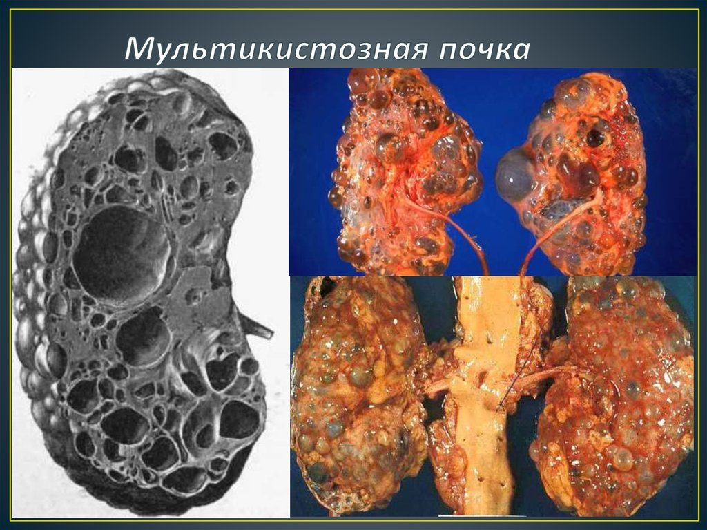 Мультикистоз правой почки у детей