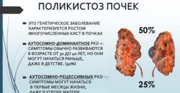 Поликистозная болезнь почек