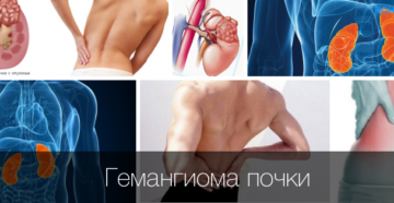 Гемангиолипома почки у мужчин