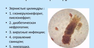 Зернистые цилиндры при пиелонефрите